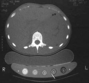 Figure 2 - Axial slice, 10 mm thick, through L2 vertebral body